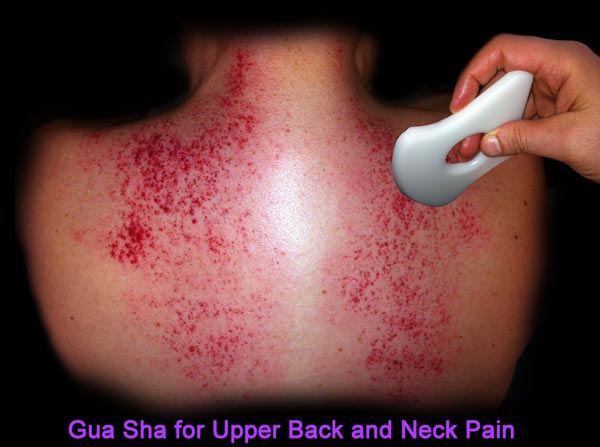 gua sha scar tissue