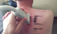 ultrasound for rib pain